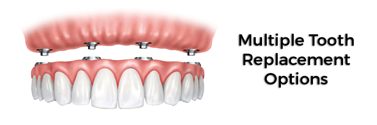 Rockville Multiple Teeth Replacement Options