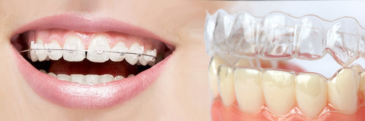Invisalign vs Braces: Which Choice is Right for You? - Arrow Smile